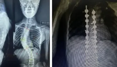 فريق طبي بجامعة بني سويف ينجح في إصلاح اعوجاج بالعمود الفقري لأحد المرضى